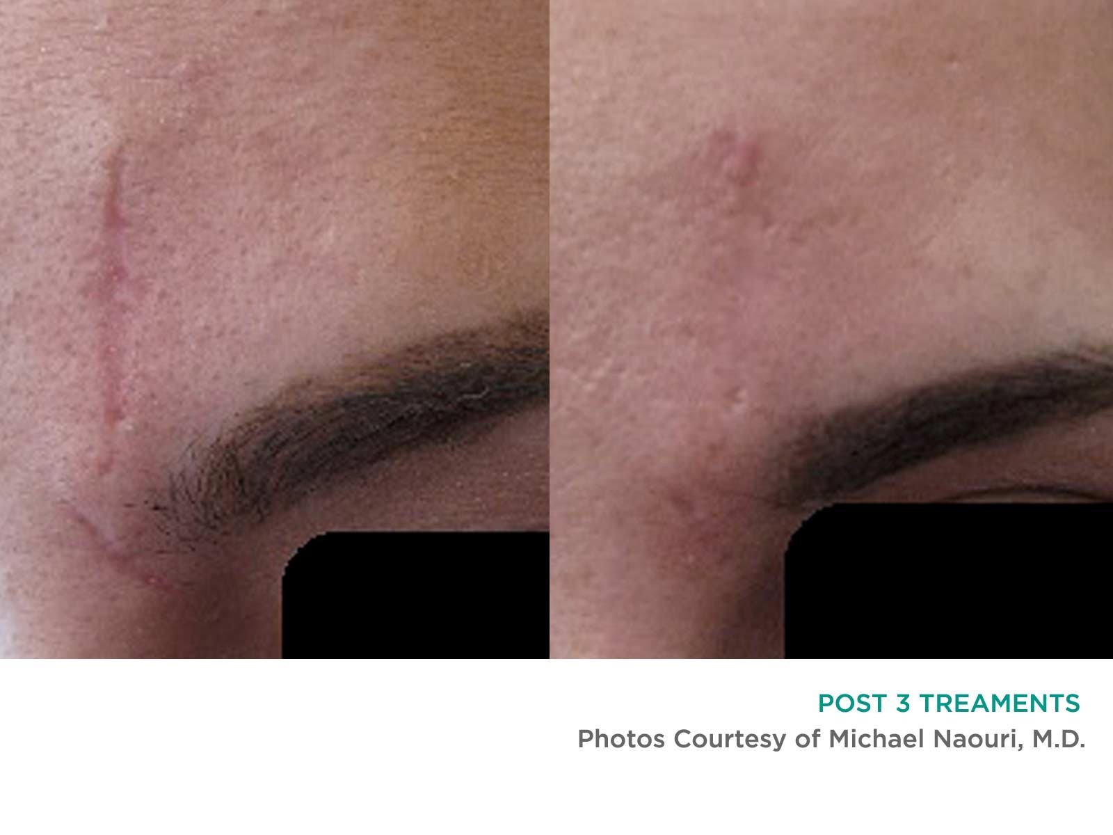 Post 3 treatments result