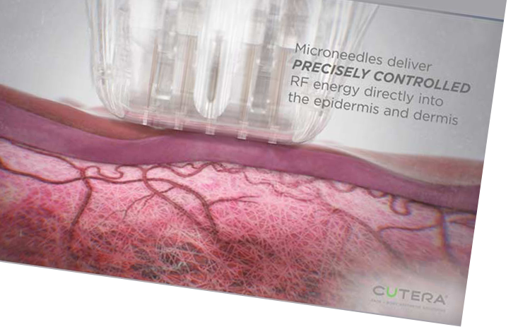 Cutera Secret RF device at Dermis Advanced Skin Care