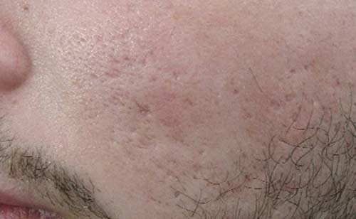 Before Secret RF treatment - Acne Scarring