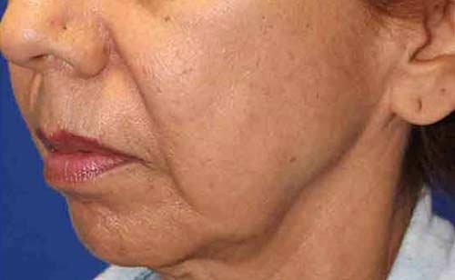 Before Secret RF treatment - Skin Texture